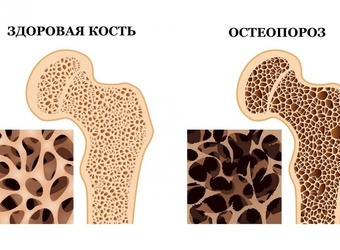 Всемирный день борьбы с остеопорозом